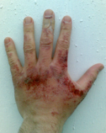 170px-Sodium_hydroxide_burn.png