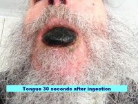 06+Tongue+30+seconds+after+ingestion.jpg